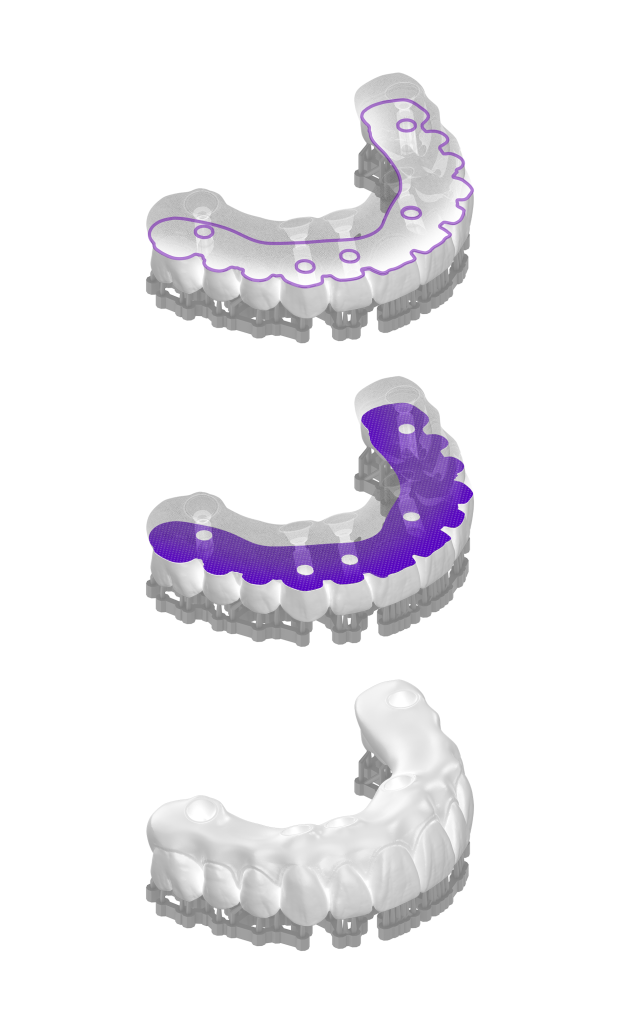 NanoCure surgical guide design to final output workflow